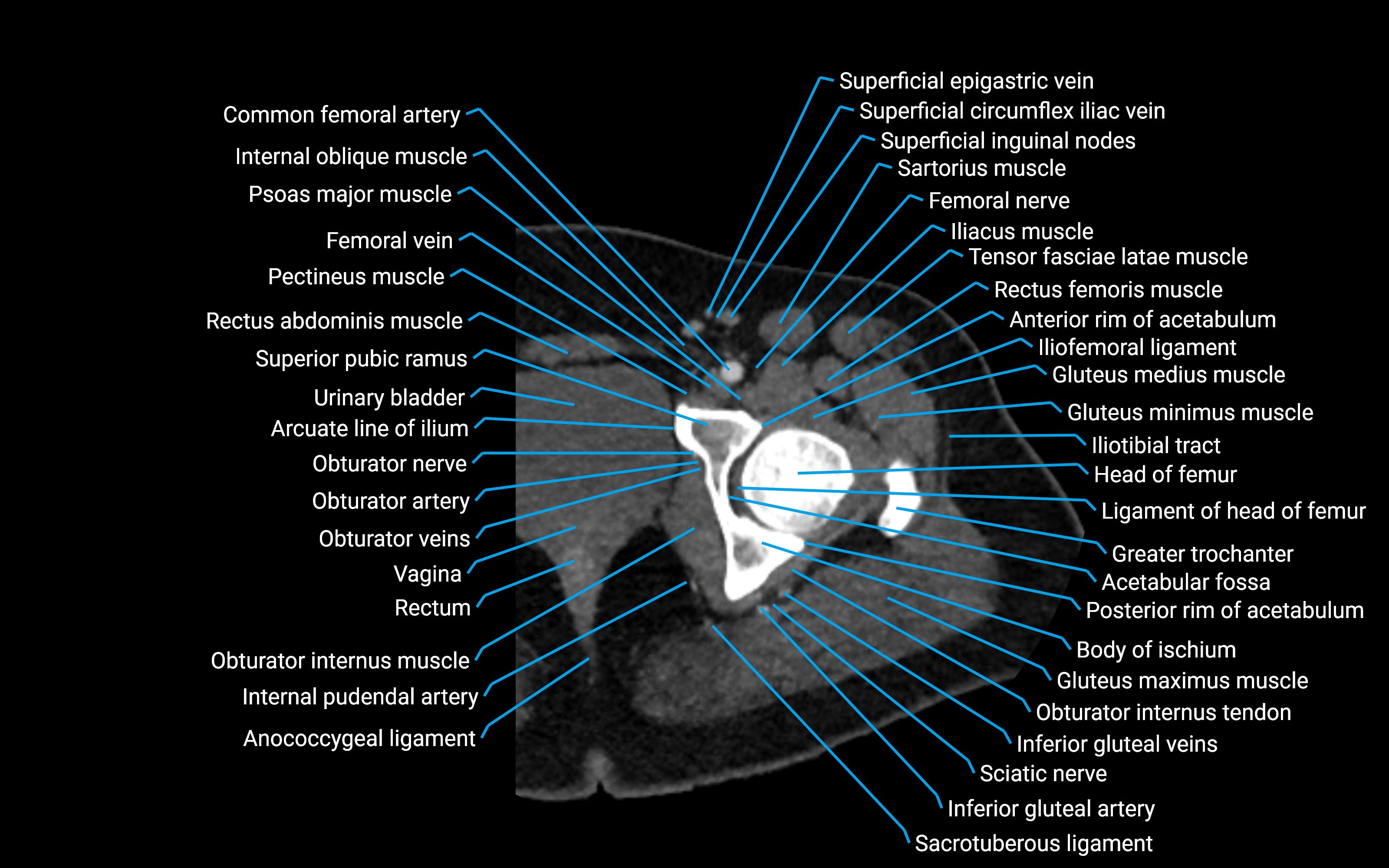 CT Hip axial cross sectional anatomy labelled image 8 (1).png